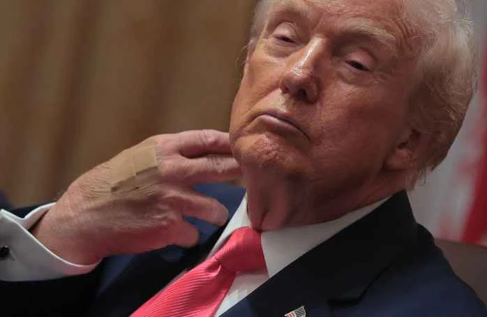 Trump explains the cause of his "bruises on the back of his hand": 25 years of continuous high-dose aspirin use.